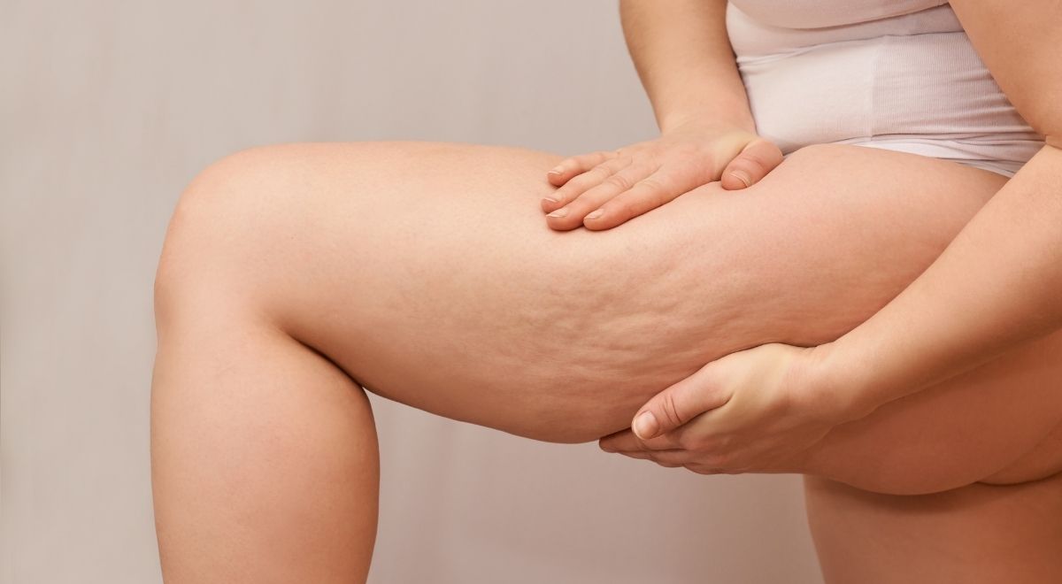 ¿Qué es la celulitis y por qué aparece en las piernas?